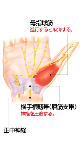 手根幹症候群 説明図